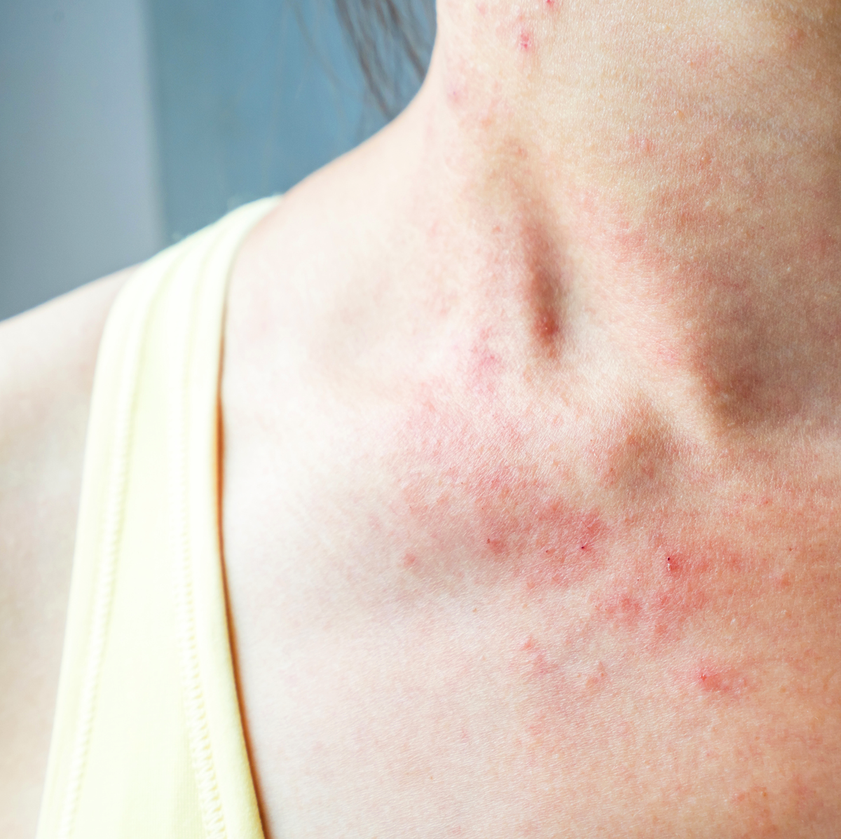 Høflig Døds kæbe radioaktivitet 30 Common Skin Rash Pictures - How to ID Skin Rash Symptoms