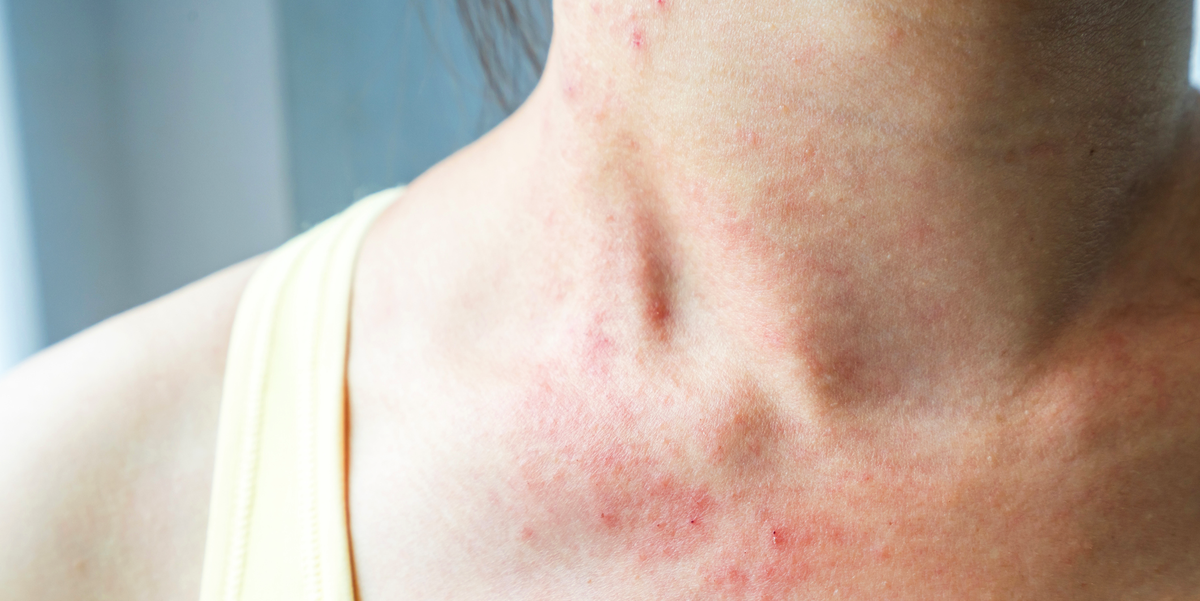 How to Tell If Your Itchy Skin Is Heat Rash This Summer