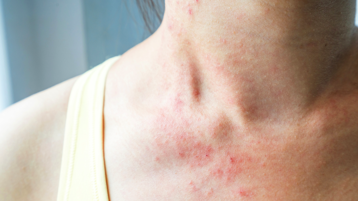 The Differences Between Rashes and Eczema (And How to Tell Which