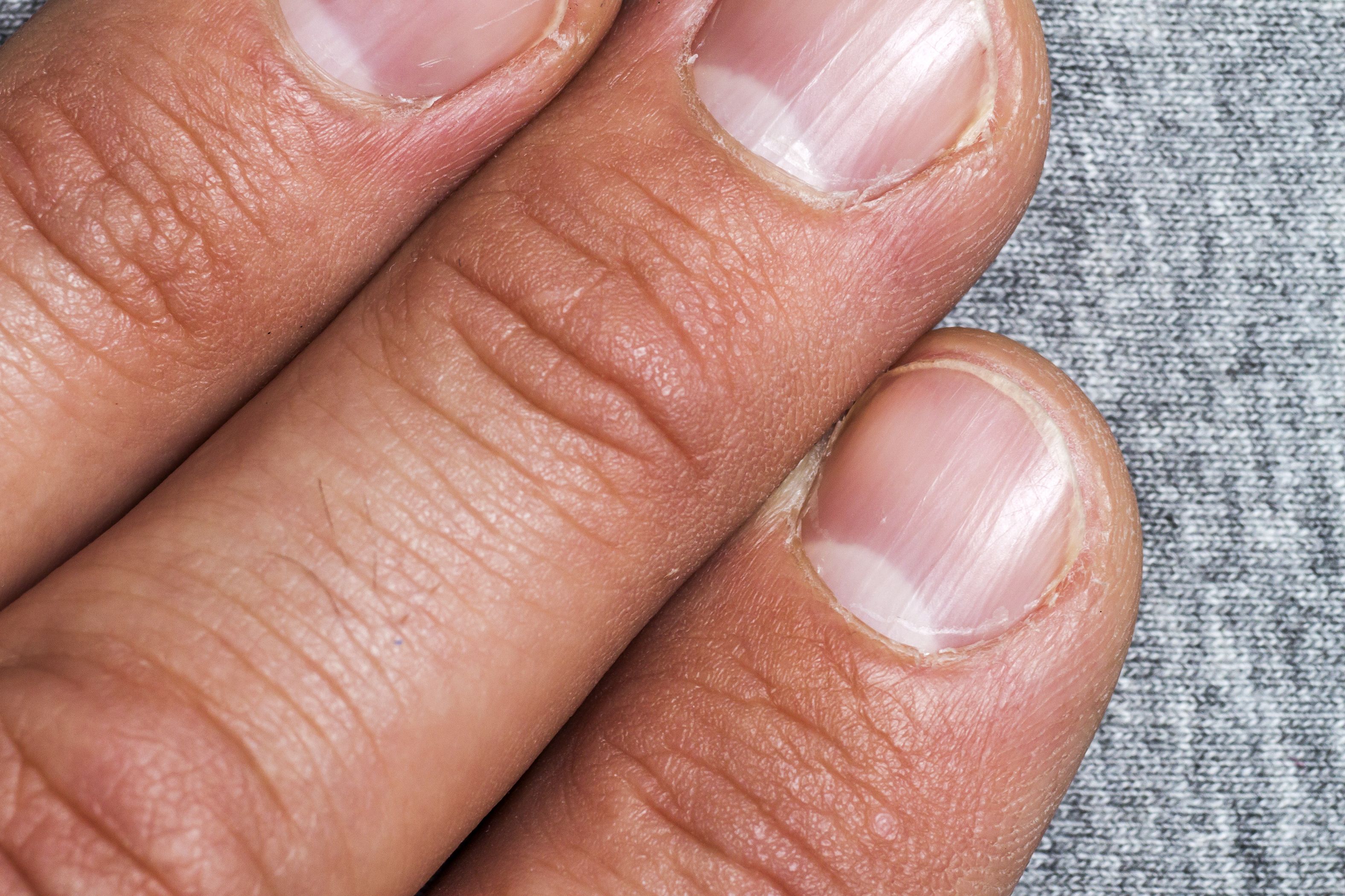 Learn About White Spots on the Nails: Causes, Prevention, and More | by  Prachi Kashyap | Medium