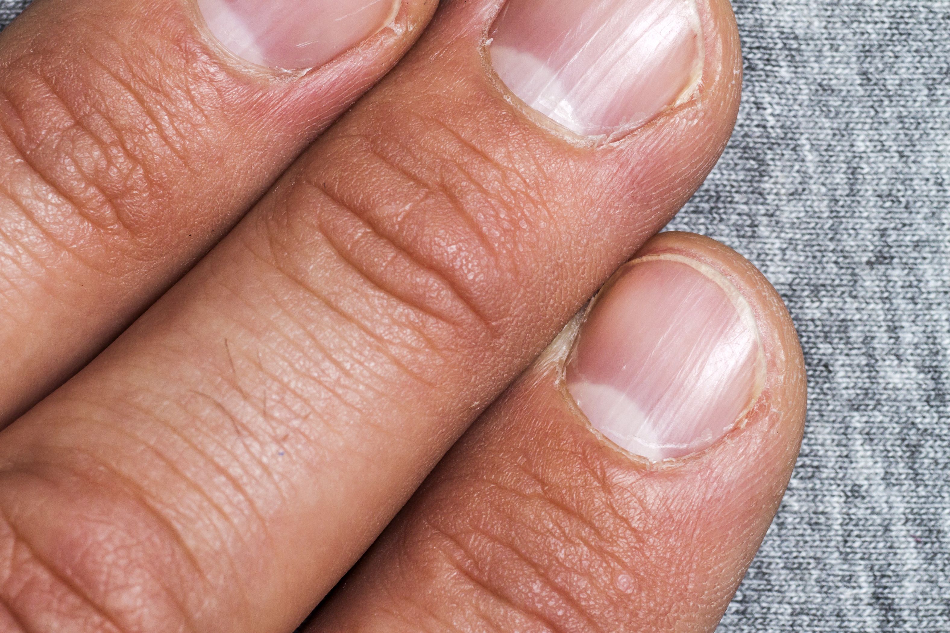 What Fingernail Health Reveals About Your Body | The Healthy