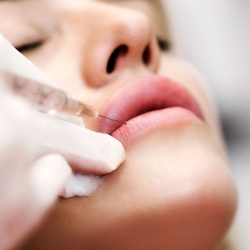 Lip Flip Botox — A woman gets a lip flip with botox