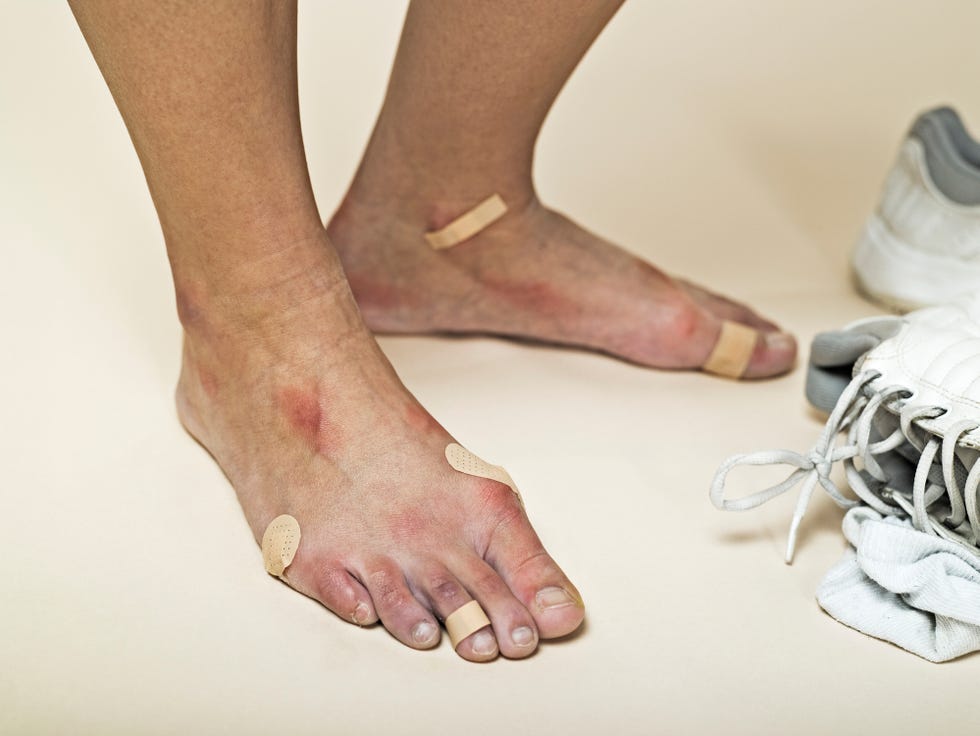 come prevenire le vesciche ai piedi