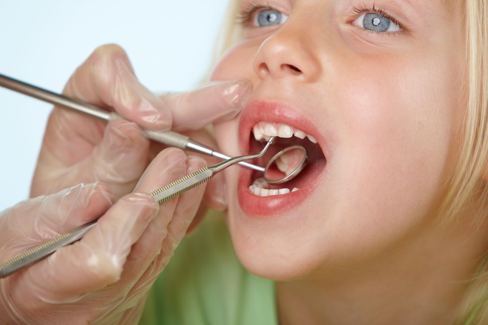 rechinar de dientes bruxismo en niños