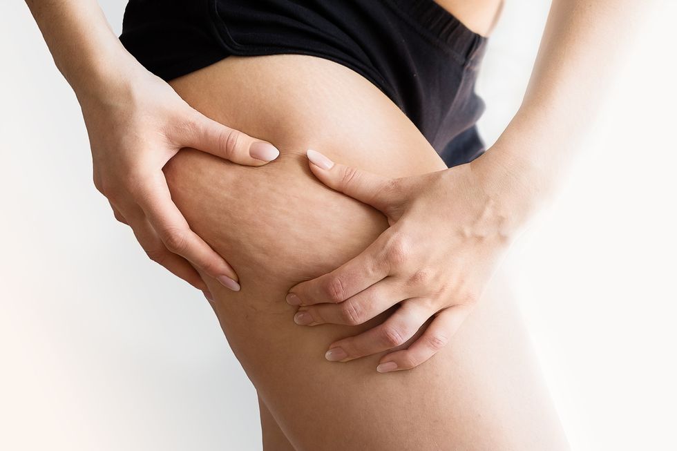 Girl shows holding and pushing the skin of the legs cellulite, orange peel. Treatment and disposal of excess weight, the deposition of subcutaneous fat tissue