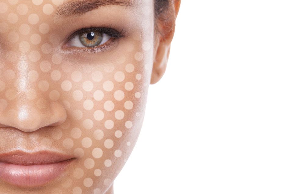 Girl with whiteheads, skin dots on face