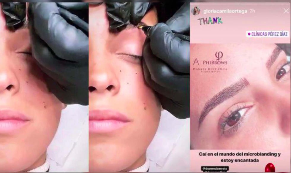 Gloria Camila se somete al microblanding