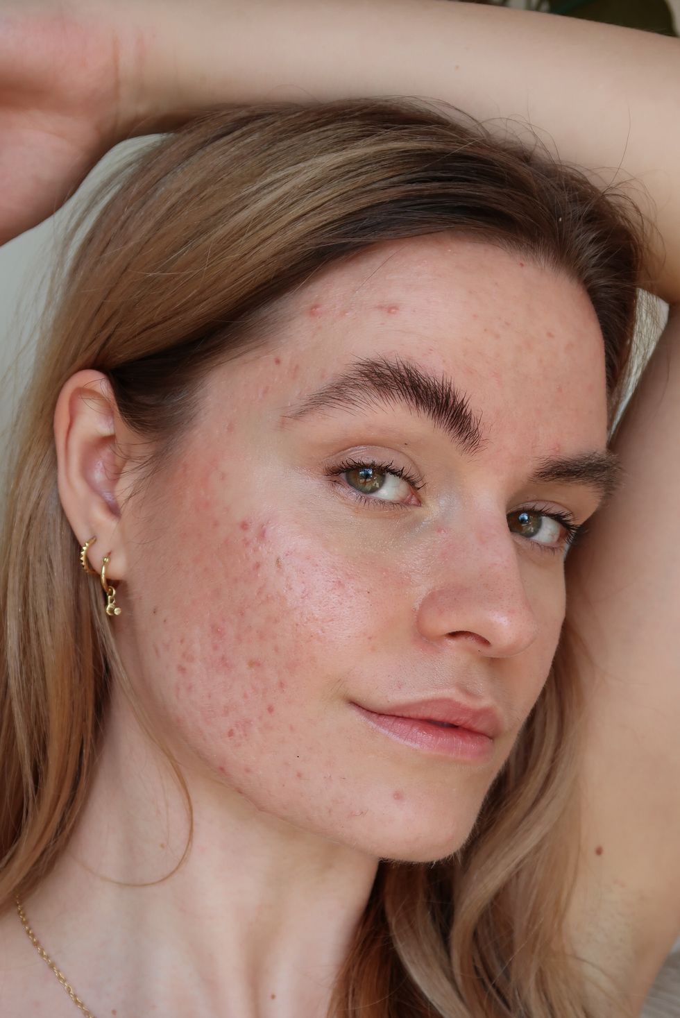 Accutane Before and After: 9 on Their Isotretinoin Side Effects