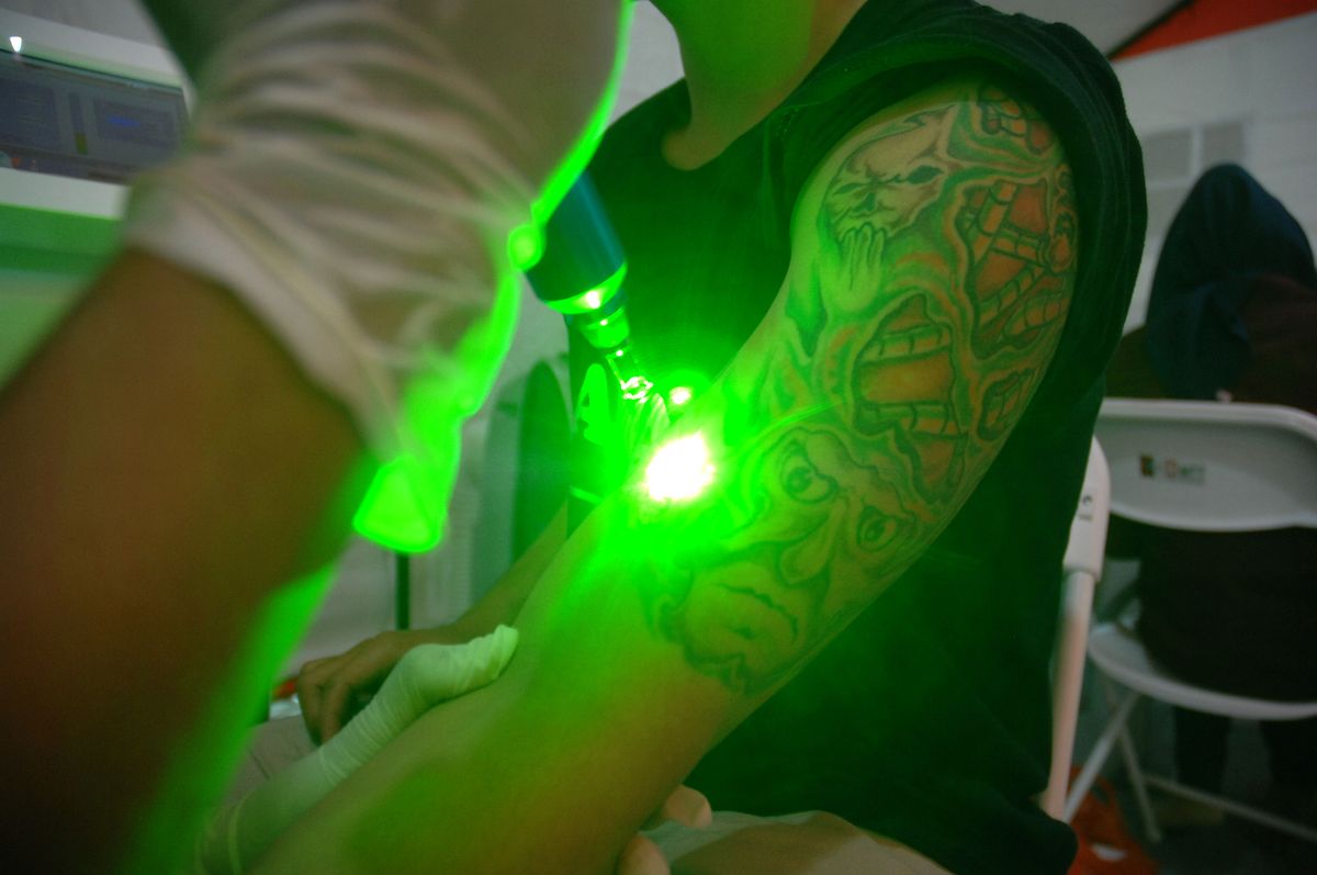 How Does Laser Tattoo Removal Work Pain Effectiveness Safety