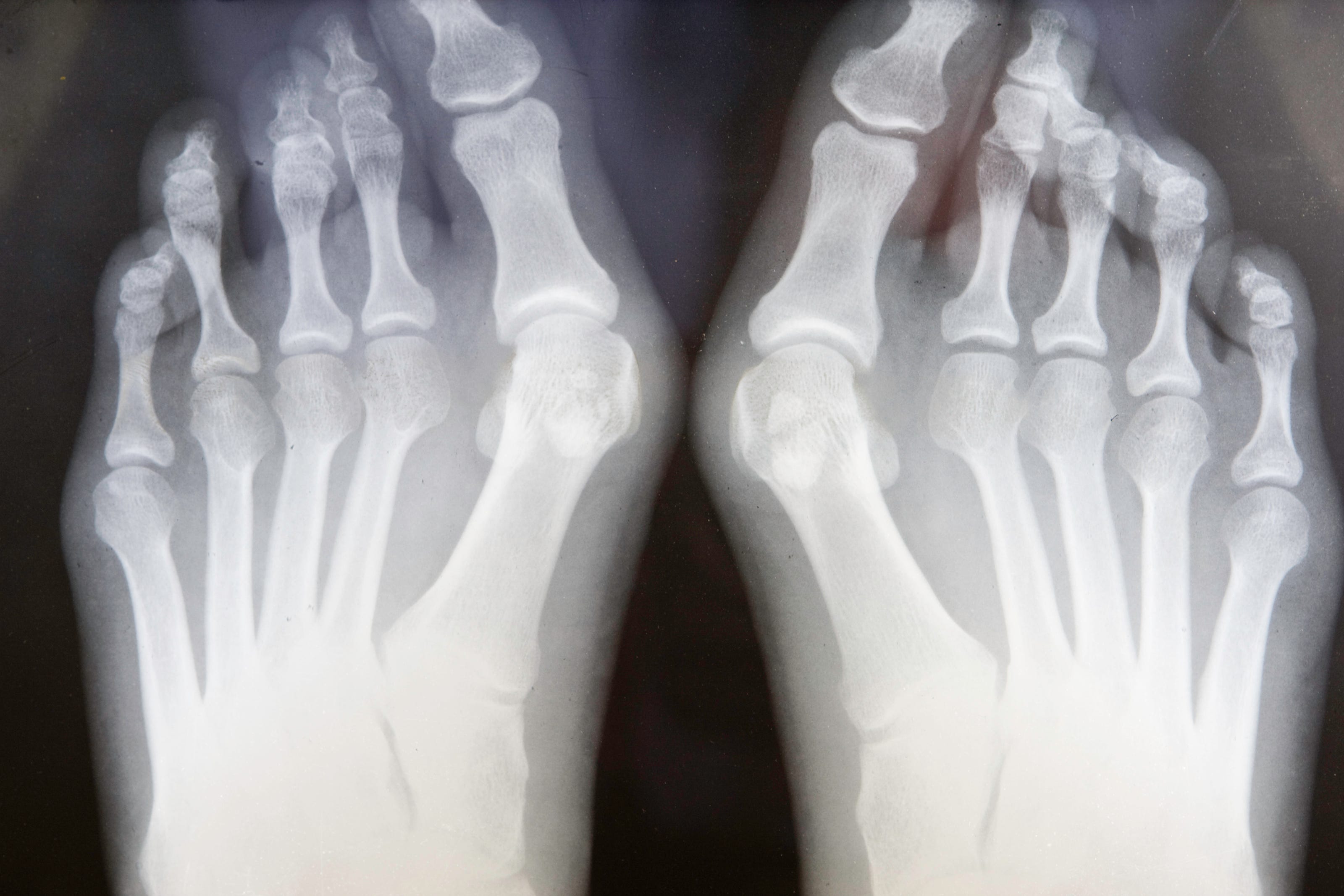 grungy x ray of feet with bunions