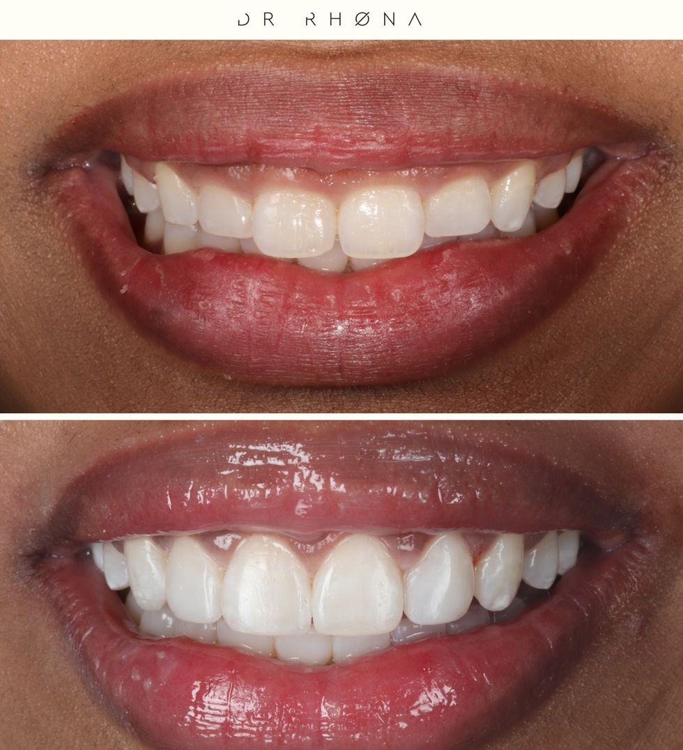 Are Gum Contouring Results Permanent? - Atlanta Smiles