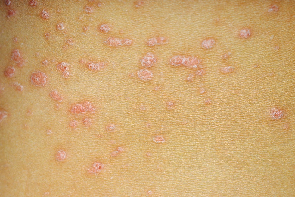 Guttate psoriasis