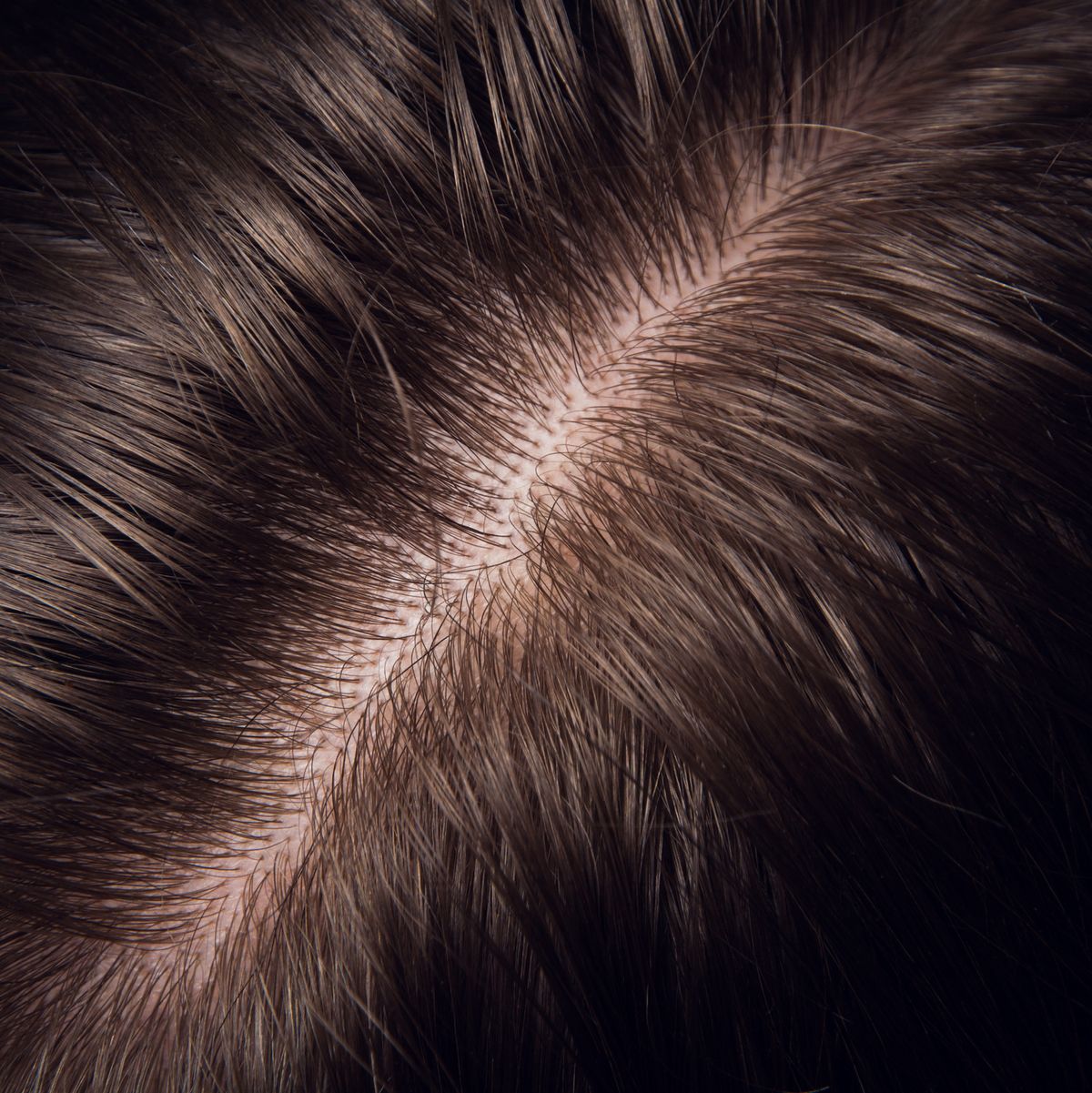 Common Scalp Conditions: Pictures, Causes and Treatments