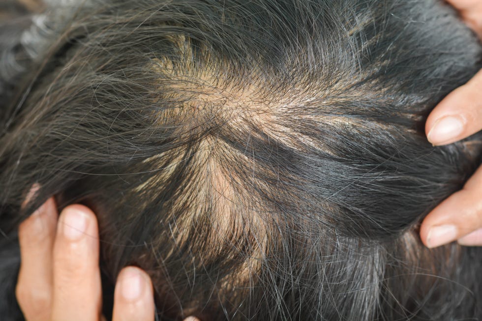 thin hair in women