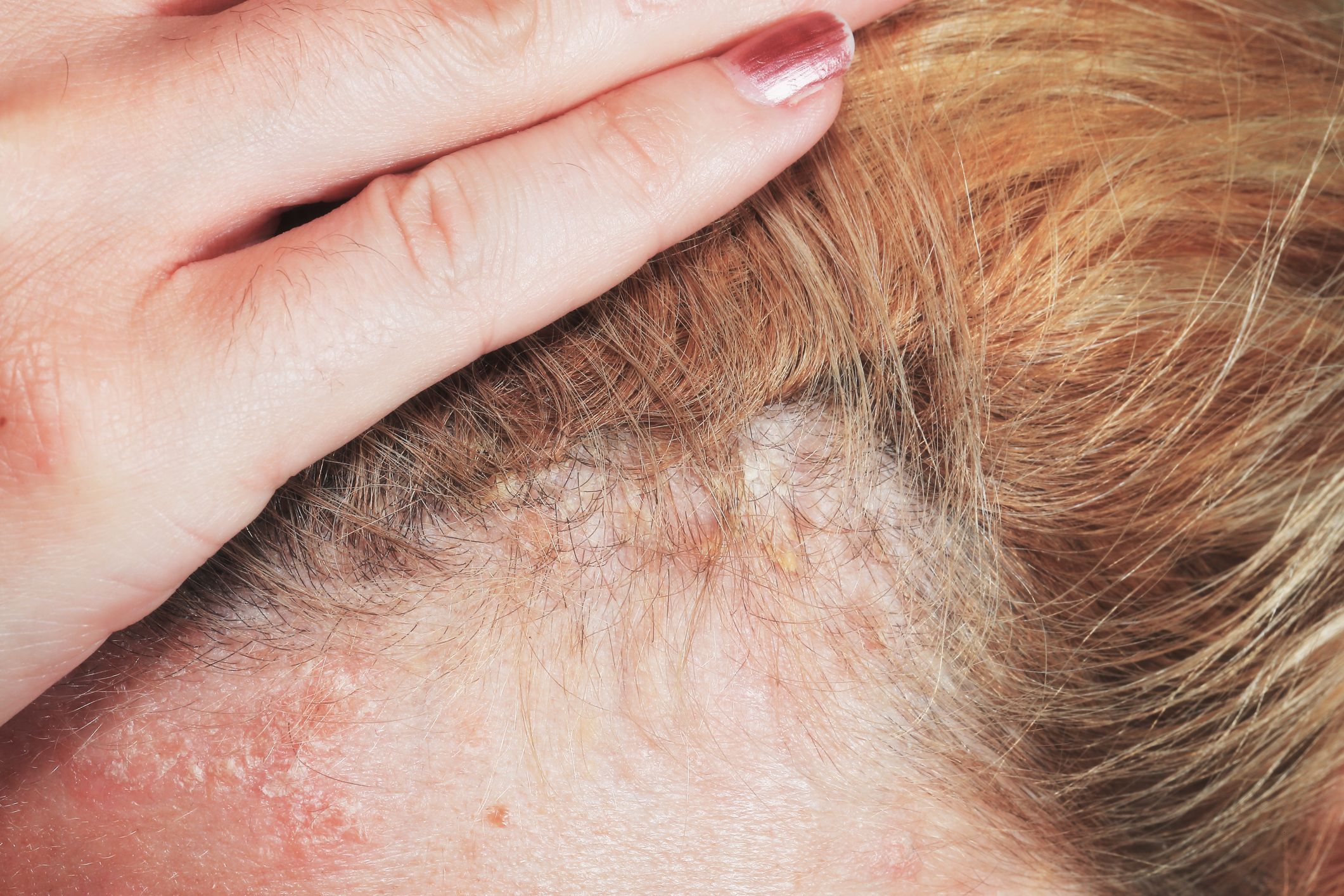 Why Is My Scalp So Itchy? - 10 Ways to Treat a Dry, Itchy Scalp