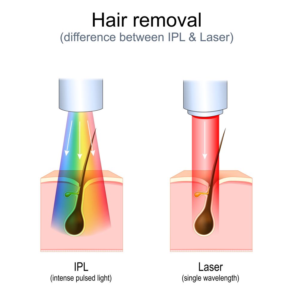 hair removal laser vs intense pulsed light ipl