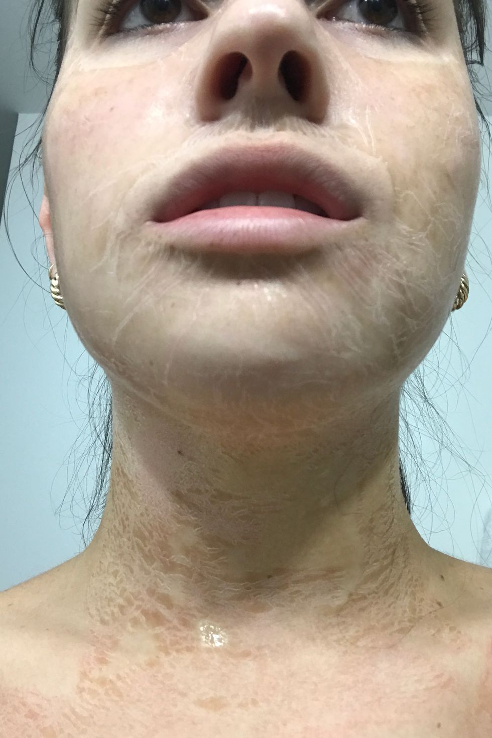 Reviewed the Hanacure Face Mask With and After Pics in