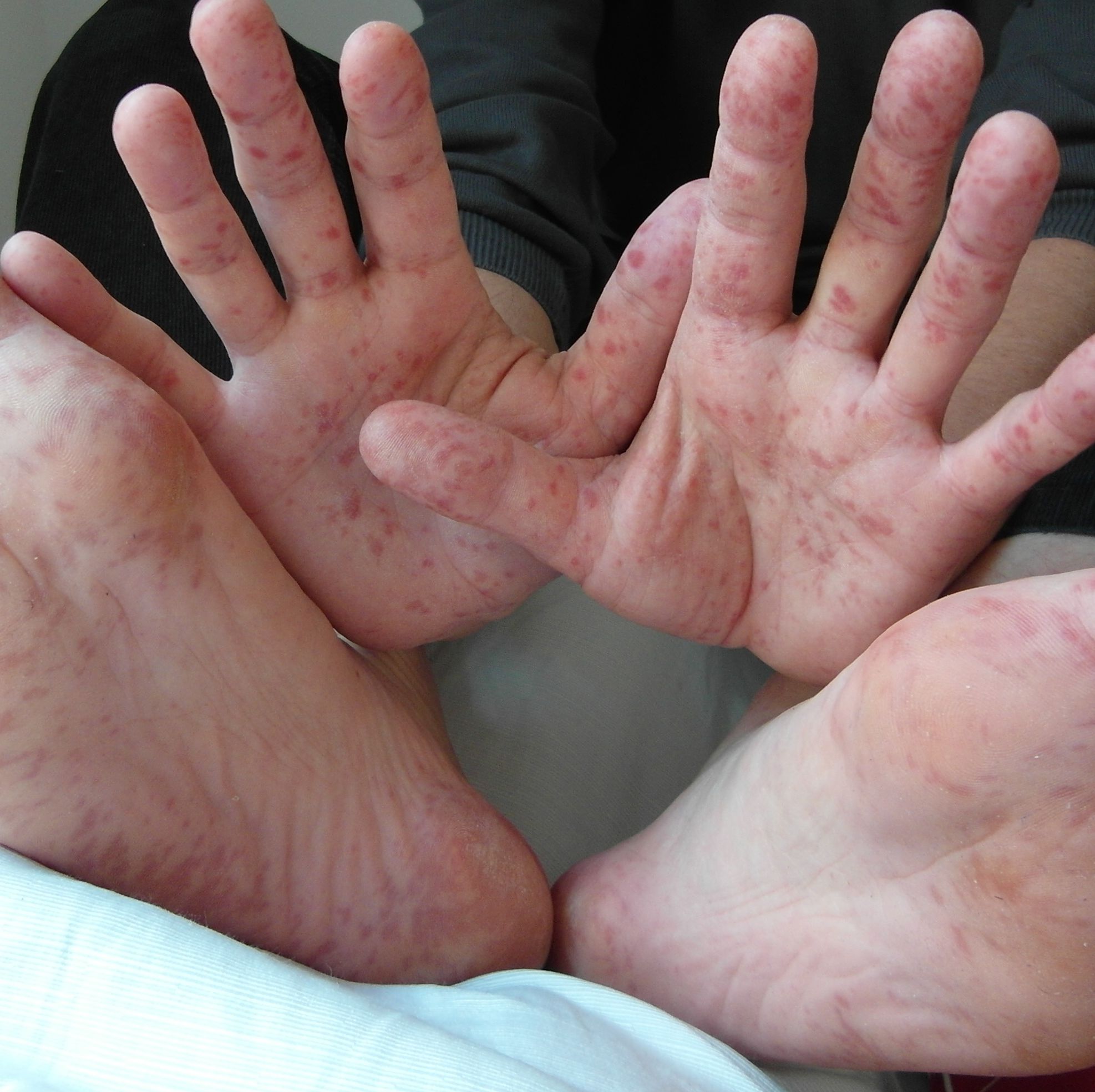 heat rash on hands and feet