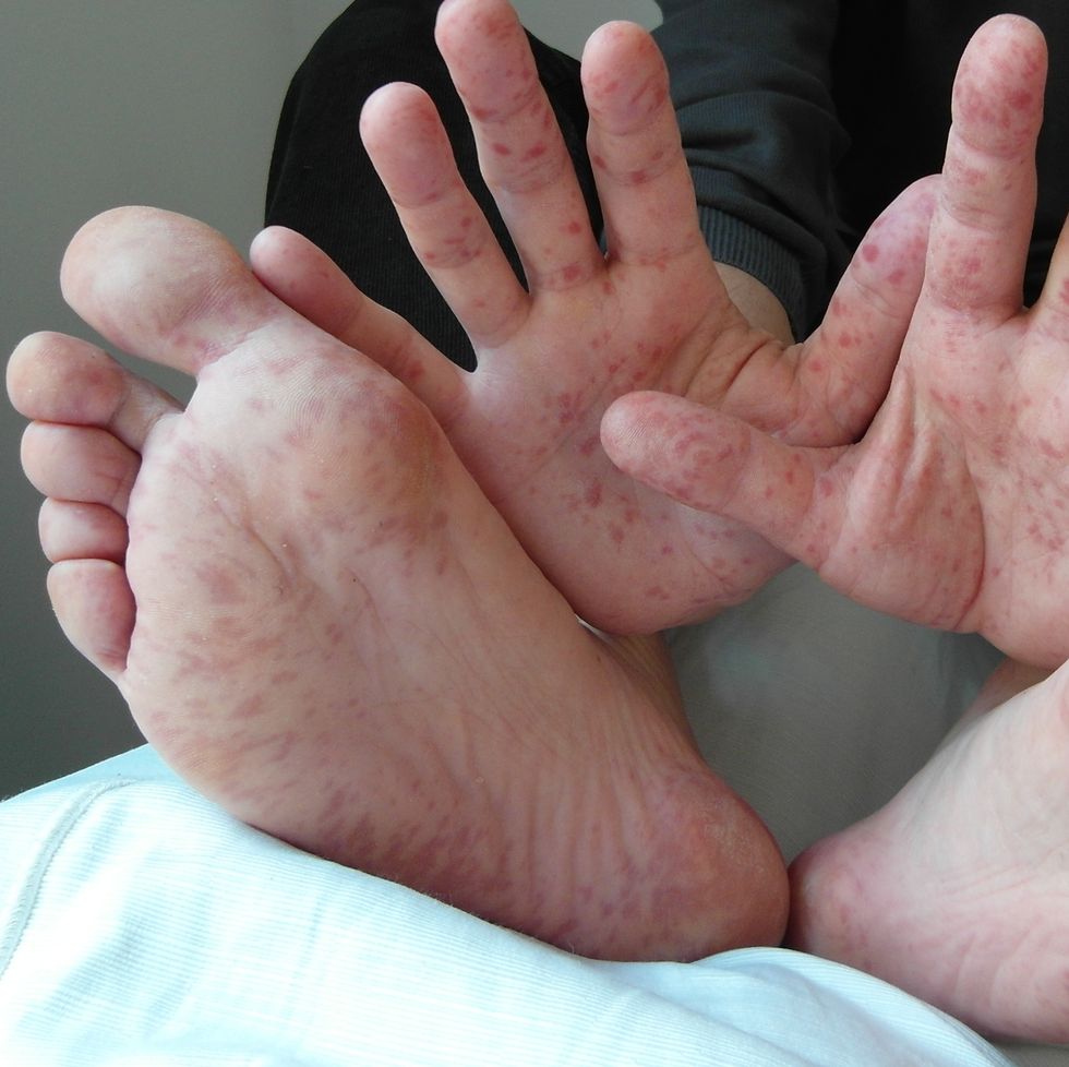 hand foot and mouth disease identification