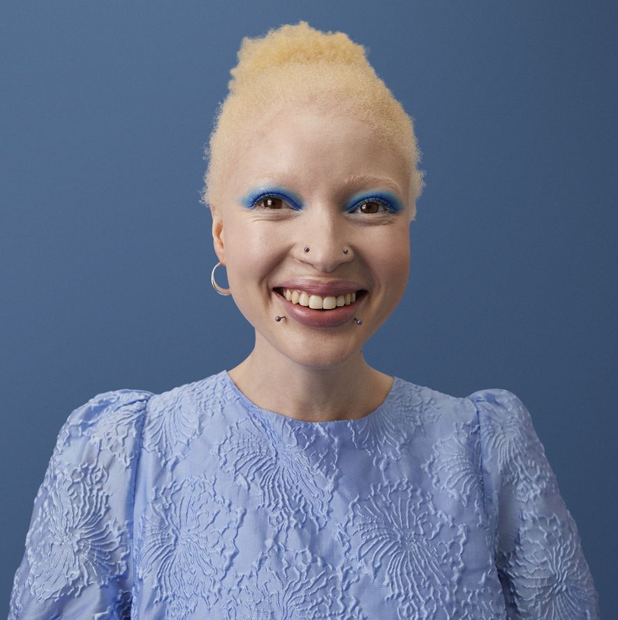 happy albino woman wearing blue dress