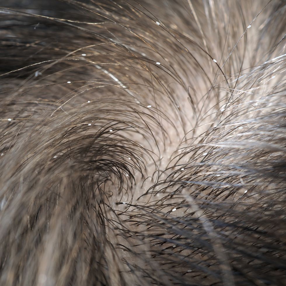 zoomed in image of lice on dark hair strands