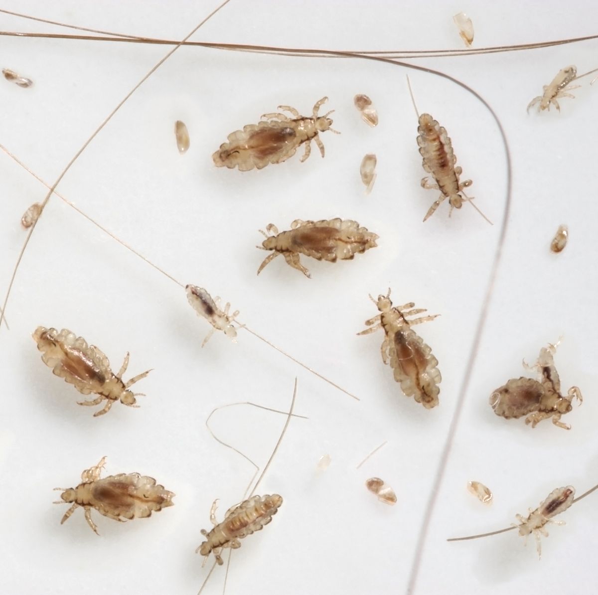 How to Get Rid of Head Lice - Best Natural Head Lice Remedies