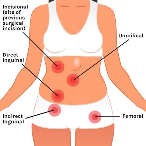 types of hernias