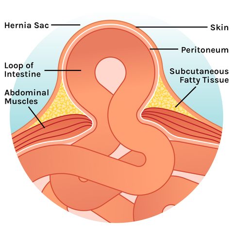 what does a hernia look like 