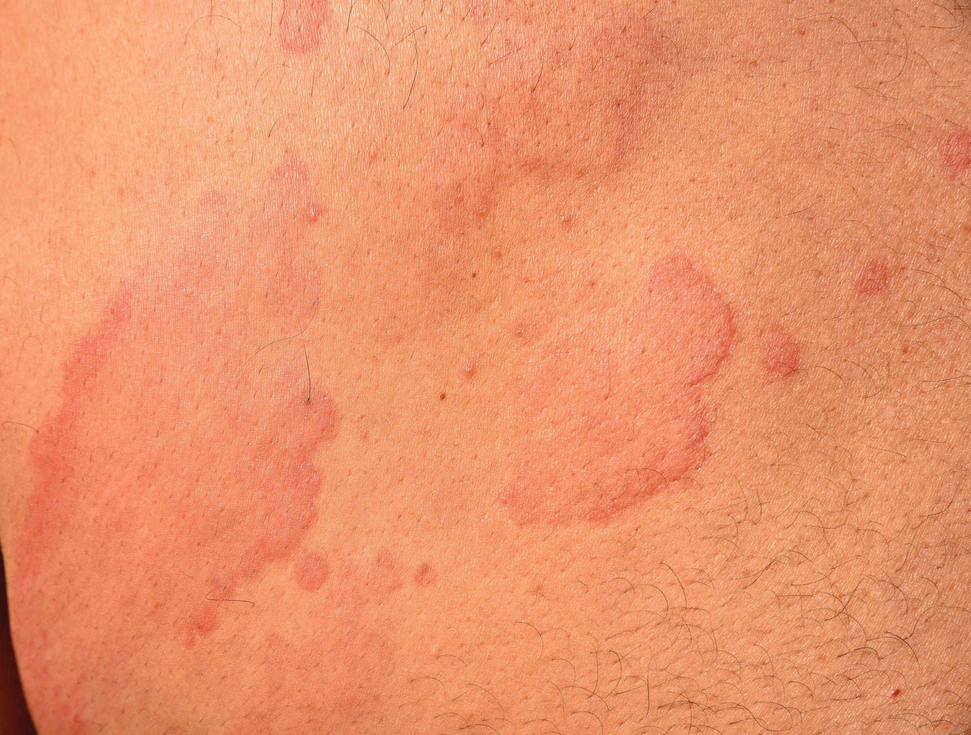 Stress Hives Causes, Treatments, and Pictures