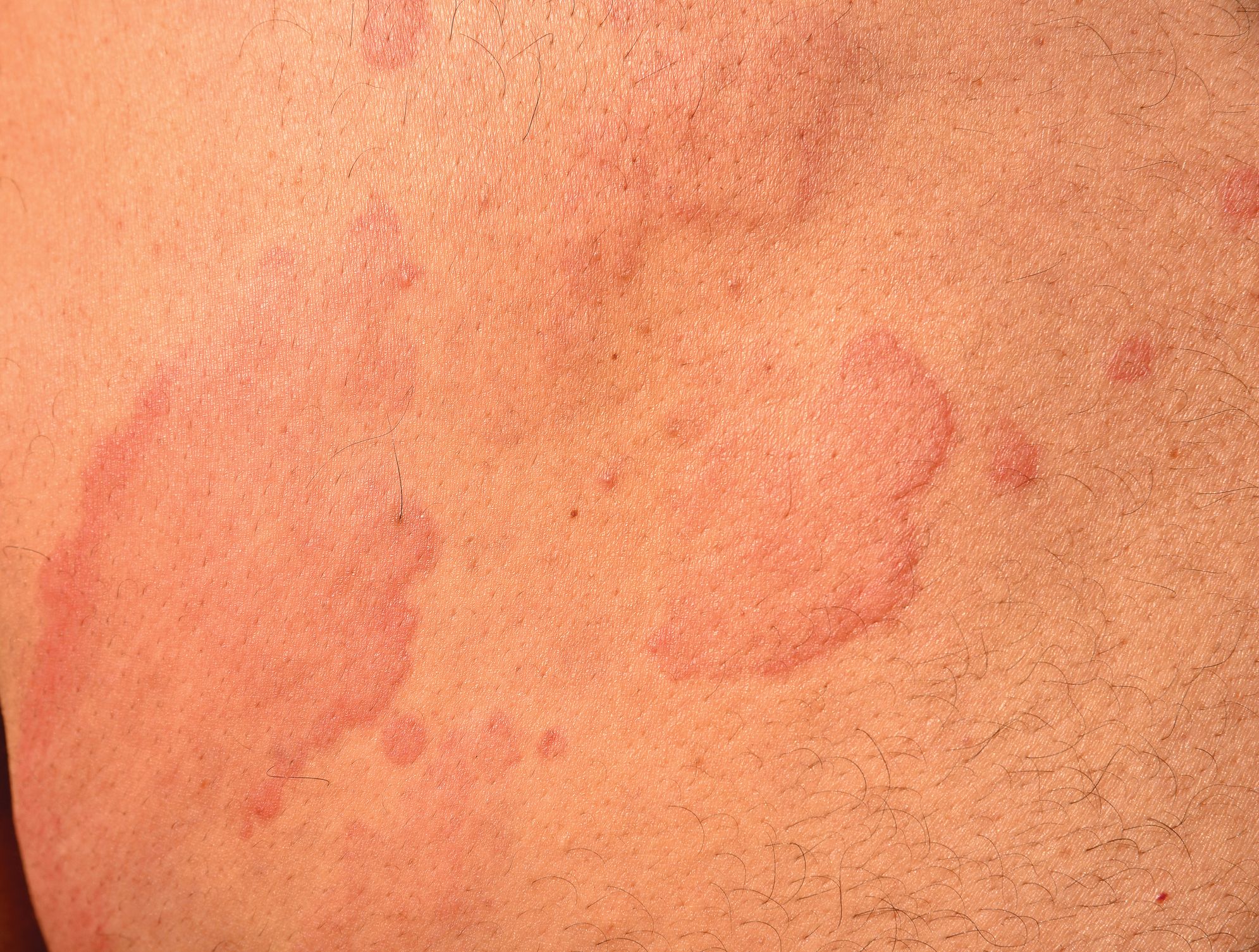 flea bite allergic reaction