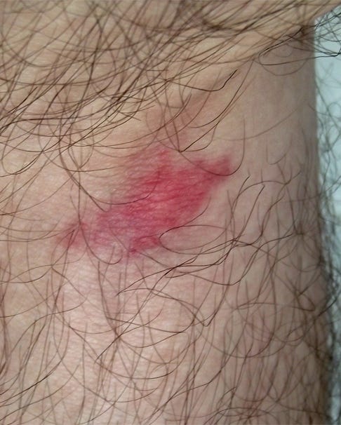 horse fly bite