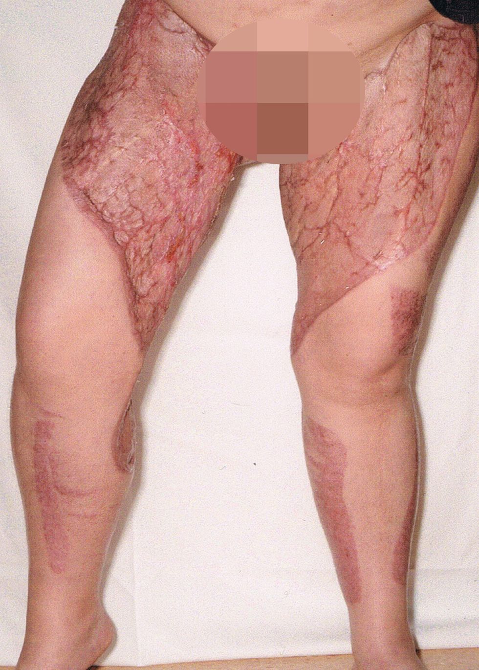 This woman developed a flesh-eating infection from her razor after