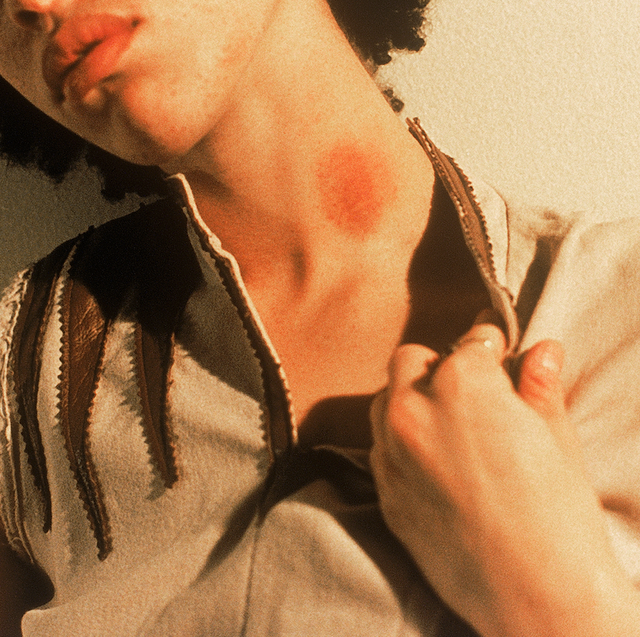 How to Get Rid of a Hickey: 12 Tips to Try in 2024