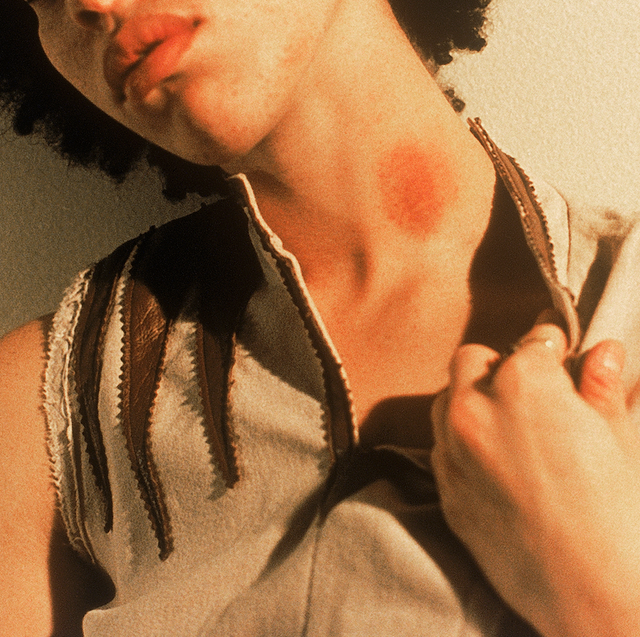 How to Get Rid of a Hickey: 12 Tips to Try in 2024