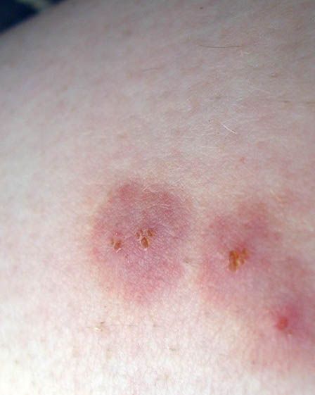 19 Common Bug Bite Pictures - How to ID Insect Bites and Stings