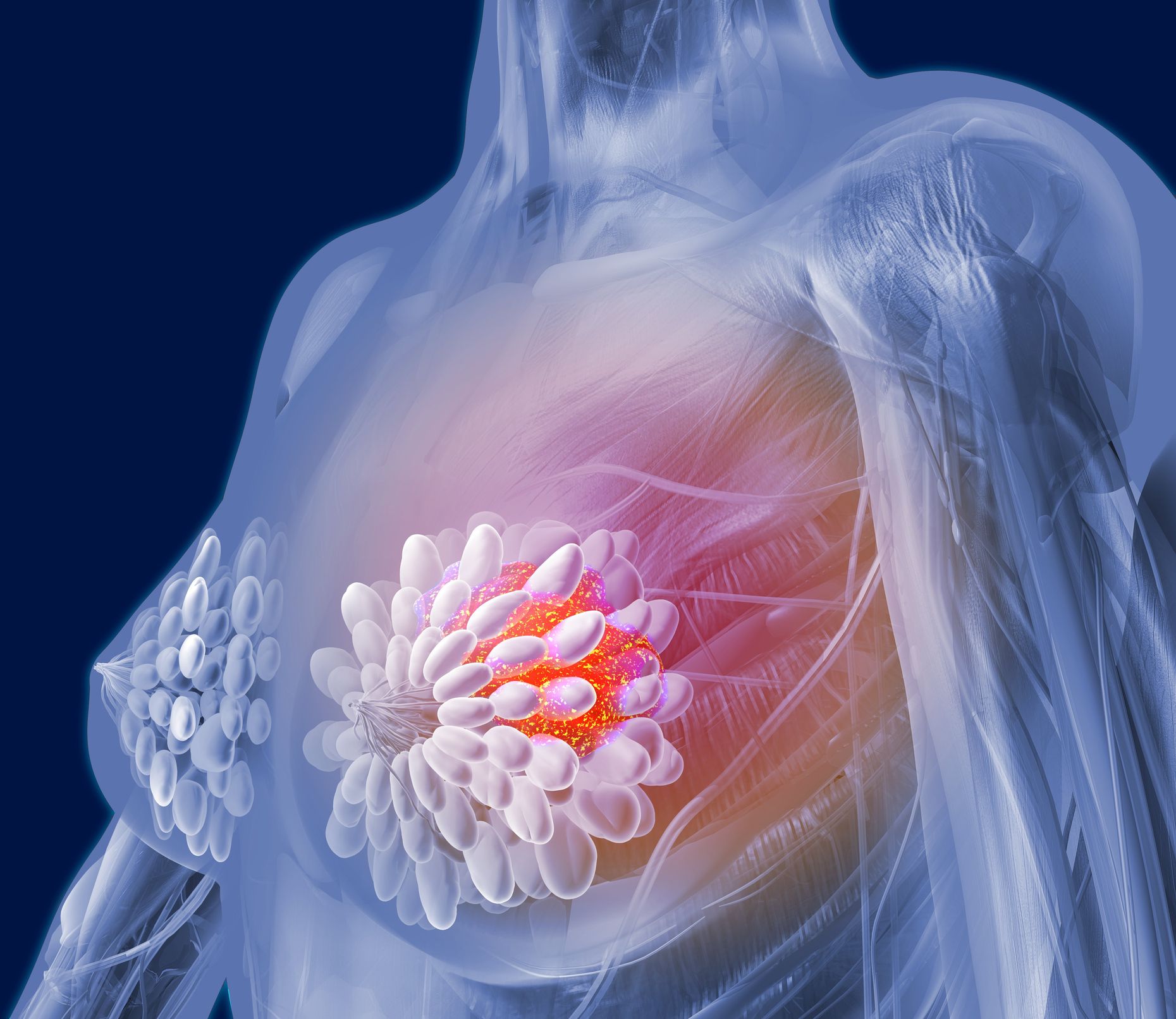 10 Ways to Prevent Breast Cancer - Breast Cancer Prevention Tips