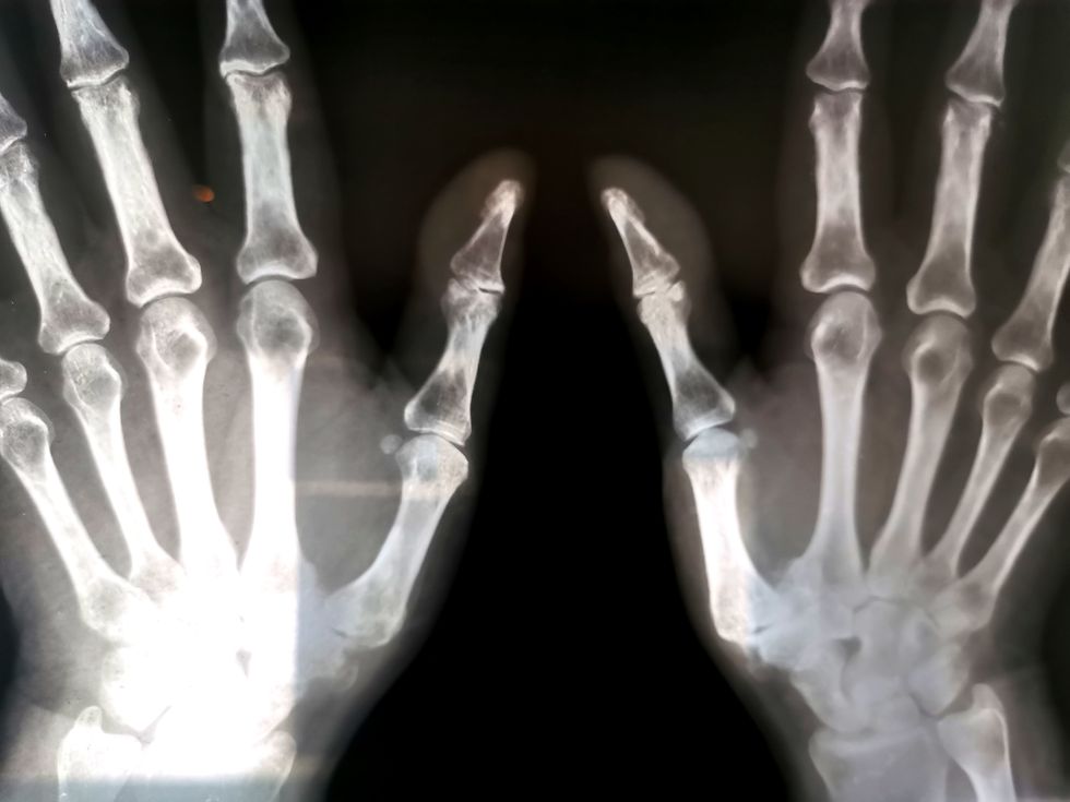 Human hands x-ray bone scan radiography