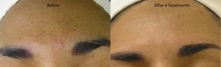 shows hydra facial effect after 4 months treatment, hydrafacial costs, where to get a hydrafacial, medical dermatology, dermatologist in nyc, nyc med spa, dermatology and laser group