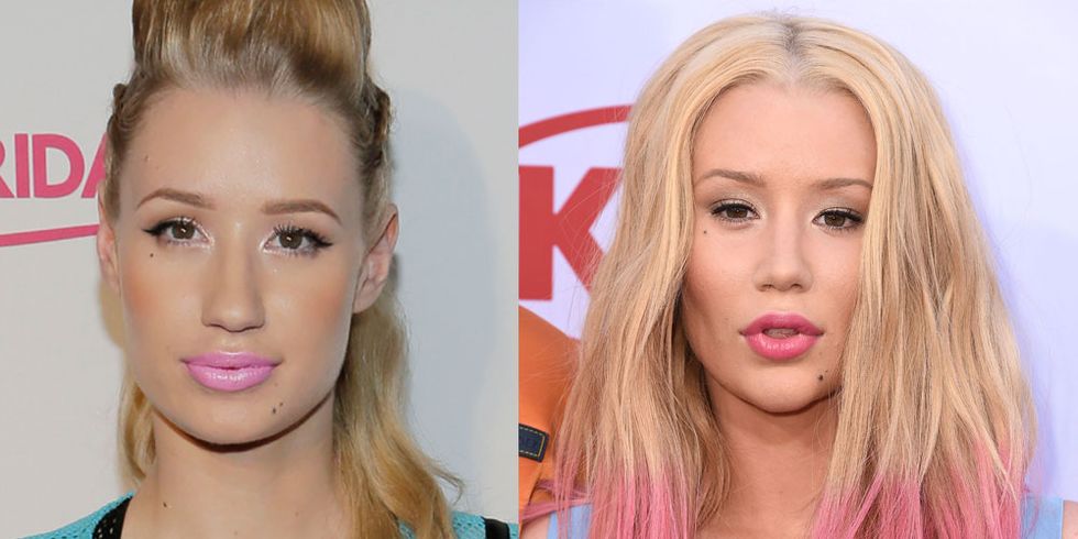 Plastic surgery before and after - 9 celebrities on what it's