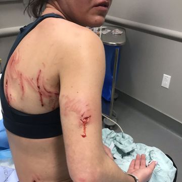 Caitlin Keen, 26, was running along Fort Worth’s Trinity Trails when a pit bull mix attacked her.