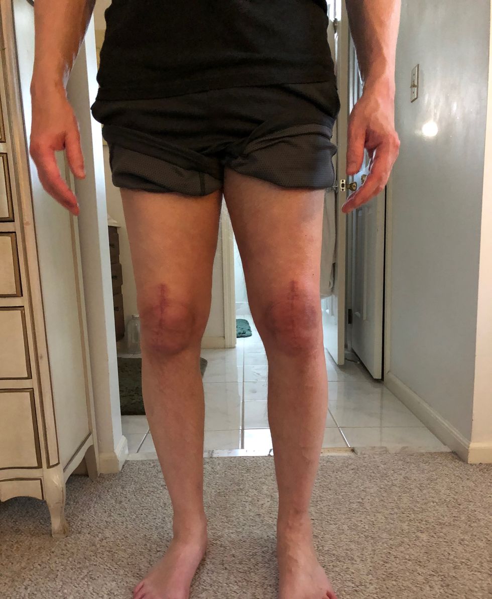 knee scars