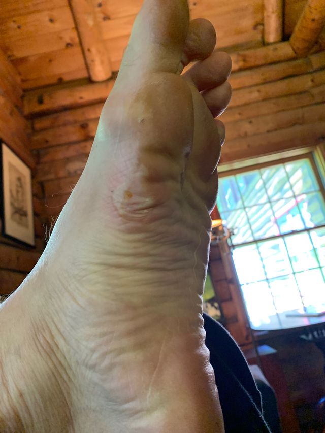 a picture of joe mcconaughy’s blistered foot after his fkt run