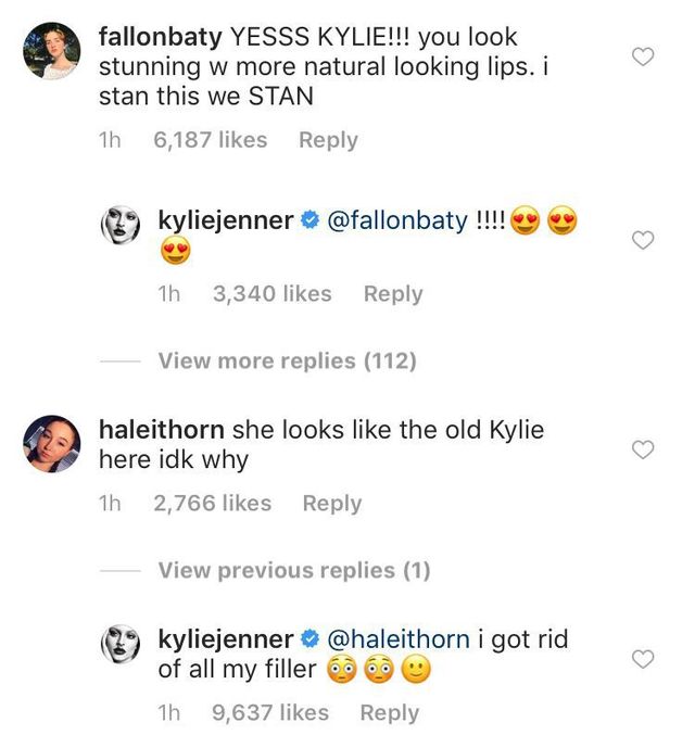 Kylie Jenner lip fillers