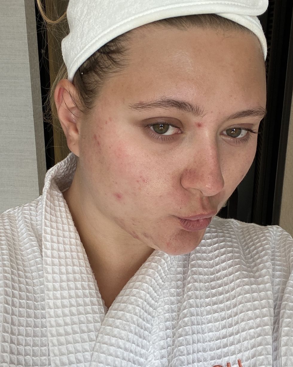 acne skincare routine
