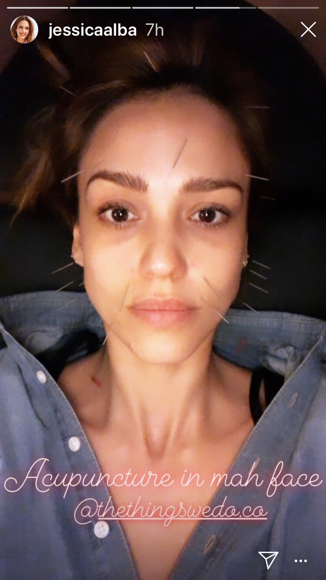 Jessica Alba Acupuncture Facial