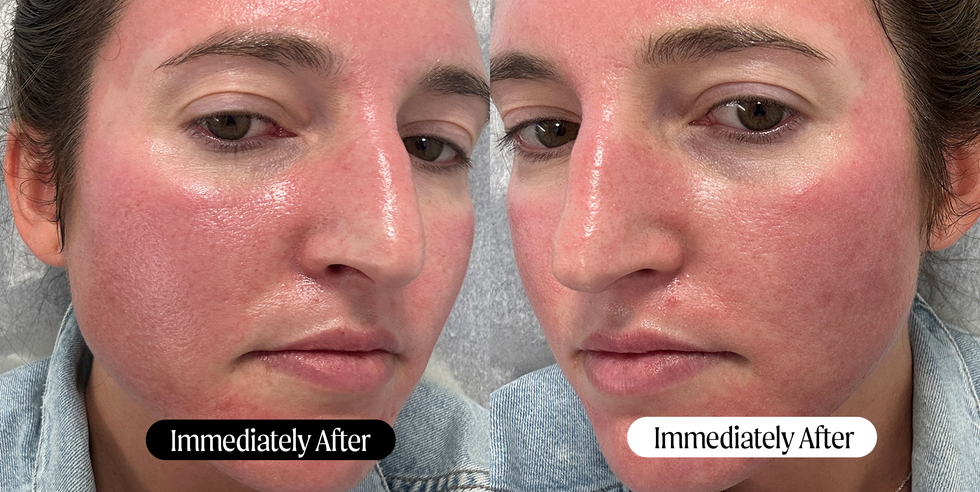 skin after halo laser