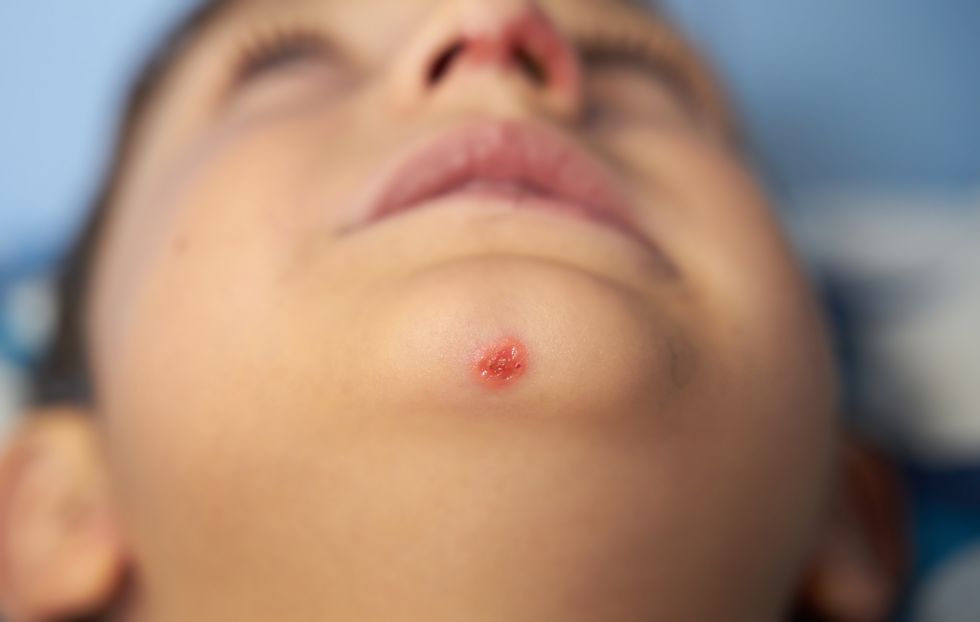 impetigo sores that form in a wound on the nose and chin