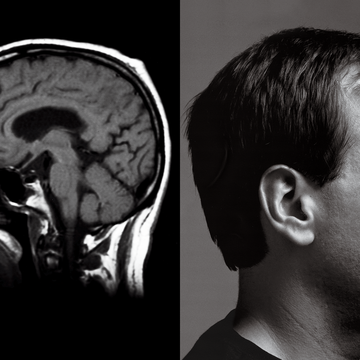 diptych of a brain scan and profile photo