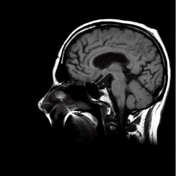 diptych of a brain scan and profile photo