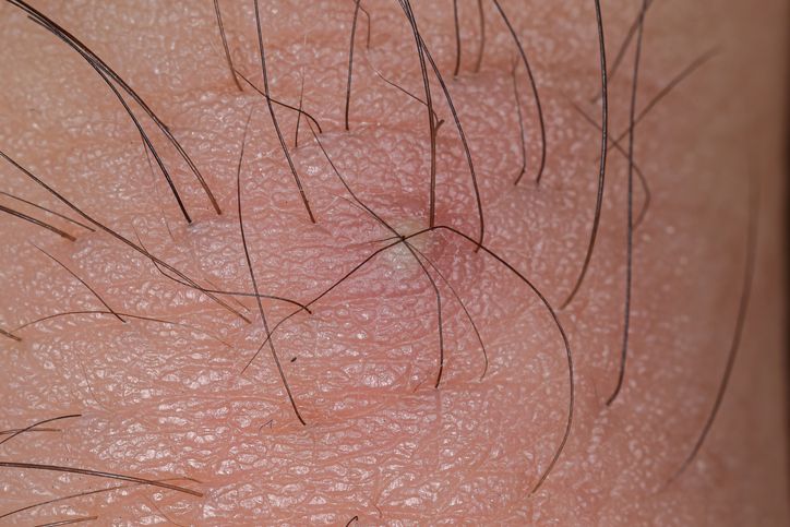 Lumps & Bumps - Cause for Concern?: Warrenton Dermatology & Skin